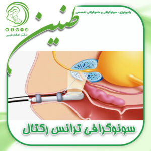 سونوگرافی ترانس رکتال