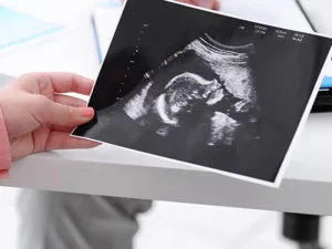 سونوگرافی NT چگونه انجام یم شود؟