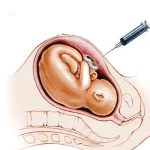 نحوه انجام آزمایش آمنیوسنتز