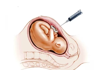 نحوه انجام آزمایش آمنیوسنتز
