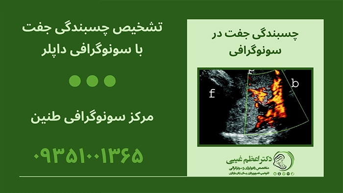 چسبندگی جفت در سونوگرافی