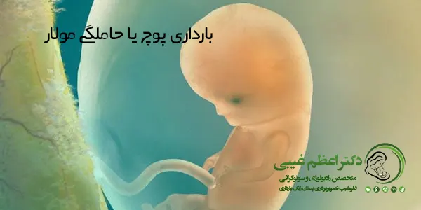 بارداری پوچ یا مولار نوعی ناهنجاری است که در هنگام باروری تخمک توسط اسپرم رخ میدهد و با وجود تقسیم سلولی و مثبت شدن نتیجهی تست بارداری، منجر به رشد جنین و یا تولد نوزاد نمیشود