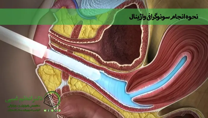 نحوه انجام سونوگرافی واژینال