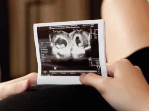 دوقلوهای ناهمسان