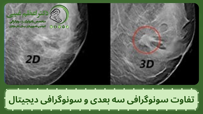 تفاوت ماموگرافی دو بعدی و سه بعدی