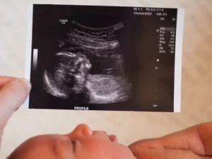 مزایای سونوگرافی سه بعدی