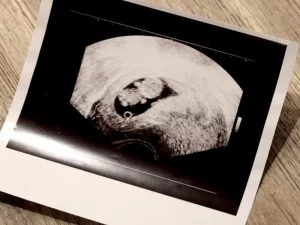 اهمیت انجام سونوگرافی سه ماهه دوم