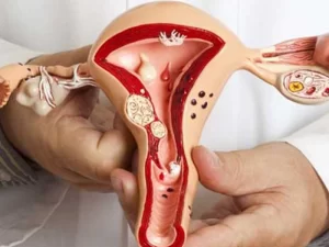 هیستروسالپنگوگرافی یا عکس رنگی رحم