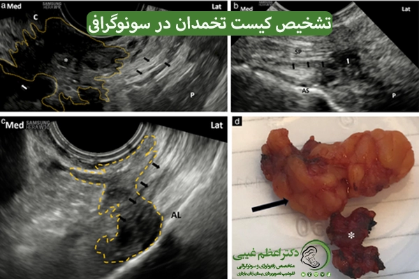 سونوگرافی اندومتریوز