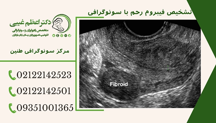 تشخیص فیبروم رحم با سونوگرافی
