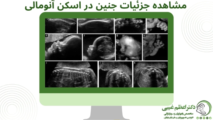 اسکن آنومالی