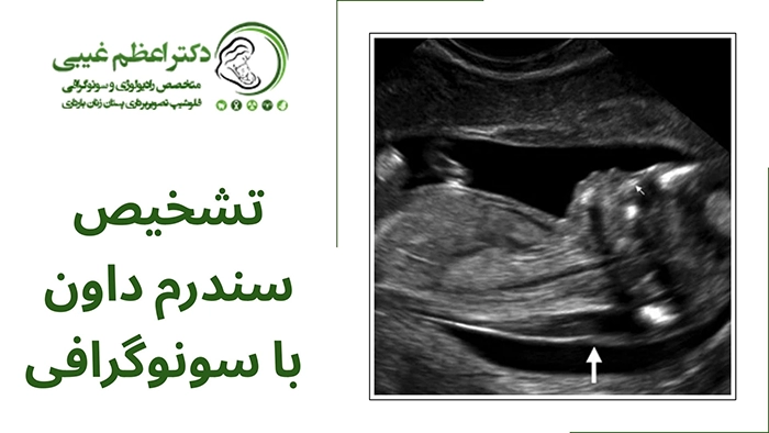 تشخیص سندرم داون با سونوگرافی