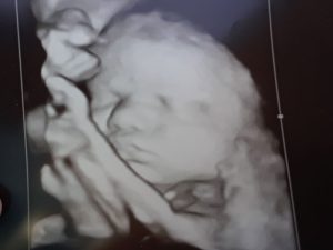 سونوگرافی-سندرم-داون