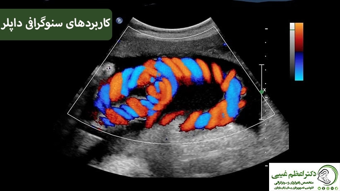 کاربرد سونوگرافی داپلر