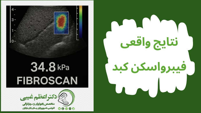 نتایج فیبرواسکن کبد