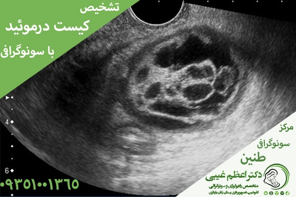 تشخیص کیست درموئید تخمدان با سونوگرافی