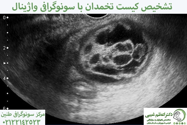 تشخیص کیست تخمدان یا سونوگرافی واژینال