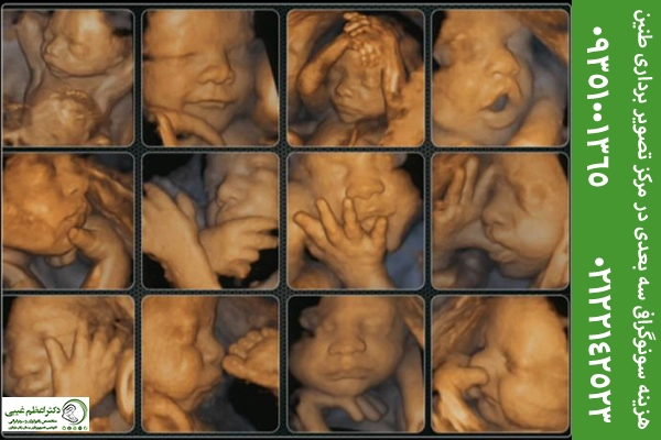 قیمت سونوگرافی بارداری