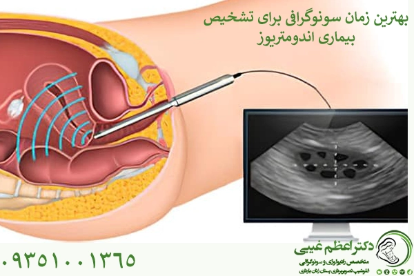 بهترین زمان سونوگرافی اندومتریوز
