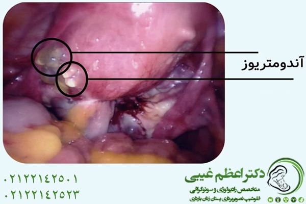 تصویر واقعی اندومتریوزیس