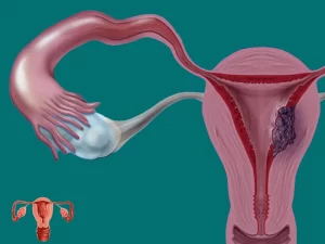 بهترین زمان سونوگرافی اندومتریوز