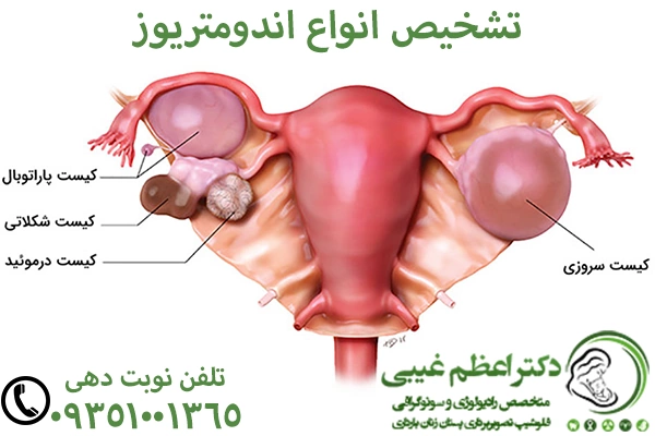 تشخیص انواع اندومتریوز رحم