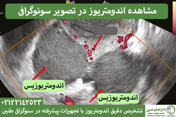 مشاهده اندومتریوز در سونوگرافی
